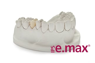 IPS e.max - All Ceramic Dental Crowns & Bridge