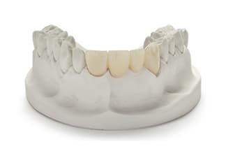 All Ceramic Dental Crowns & Bridge