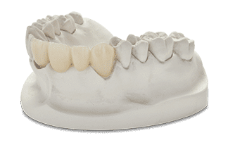 All Ceramics Crown and Bridge | Zirconia-Layered