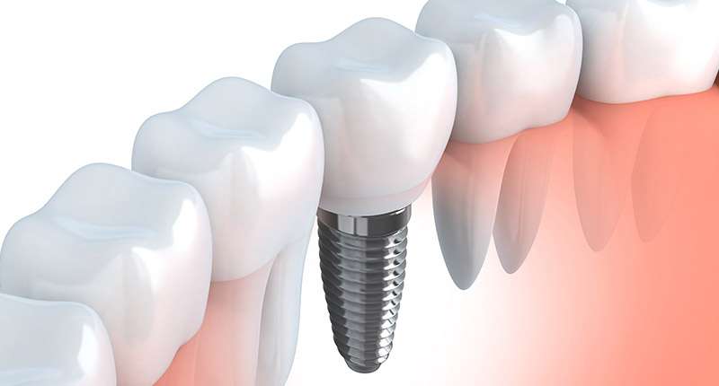 CE CLASS Dental Implants The Wave of the Future
