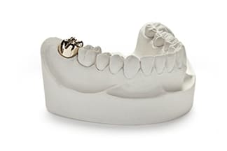 Gold Full Cast Dental Crowns & Bridges