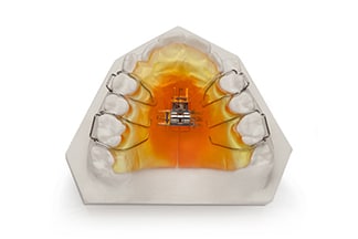 Dental Arch Development 3-Way Expander - DDS Lab's Orthodontic Products