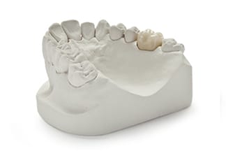 Non-Precious PFM Porcelain Fused Metal Dental Crowns & Bridges