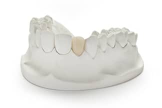 Semi-Precious PFM Porcelain Fused Metal Dental Crowns & Bridges