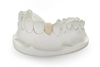 PFM Porcelain Fused Metal Dental Crowns & Bridges