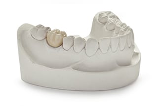 Yellow Hi-Noble PFM Porcelain Fused Metal Dental Crowns & Bridges