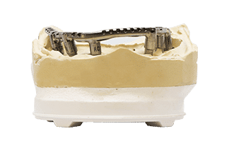 Titanium Hybrid Dentures - DDS Lab's Dental Implants