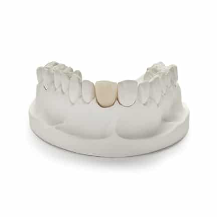 DDS Lab's Dental Crowns & Bridges Products