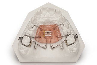 Hilgers Pendex Molar Distalizing - DDS Lab's Orthodontic Products