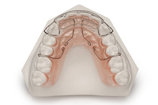 Modified Dental Spring Retainer - DDS Lab's Orthodontic Products