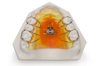 Dental Removable Expansion 3 Way Expander - DDS Lab's Orthodontic Products