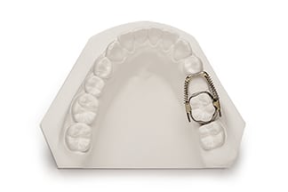 Dental Sliding Loop Regainer - DDS Lab's Orthodontic Products