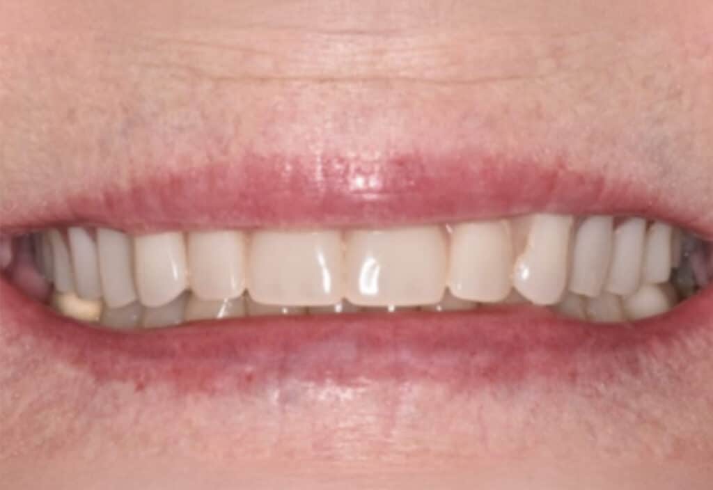 3D Printed Digital Denture