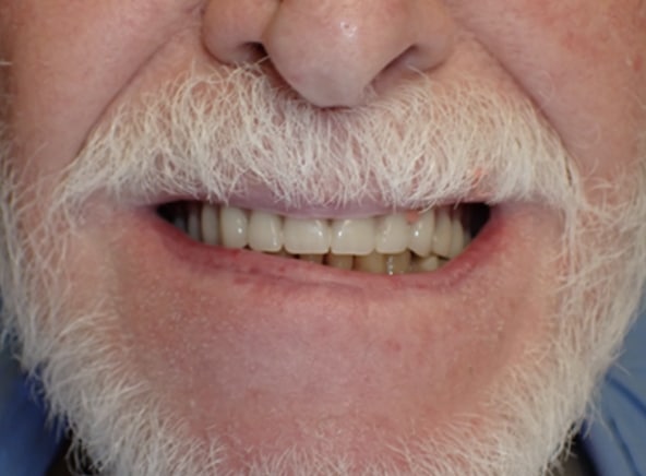 Competitive Lab #1 resin process | Dentures