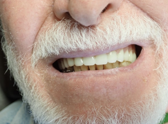 Competitive Lab #2 resin process | Dentures