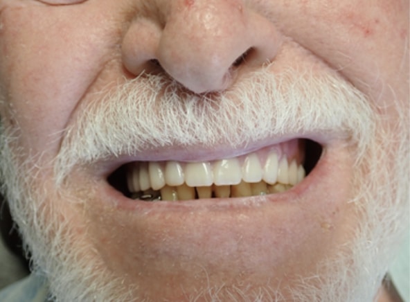 3D Printed Digital Denture | DDS Lab Full Service Dental Lab